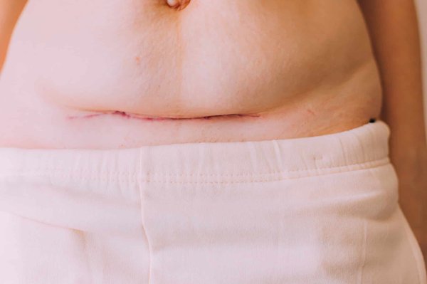 Comment réduire l'apparence des cicatrices de boutons avec des remèdes naturels?